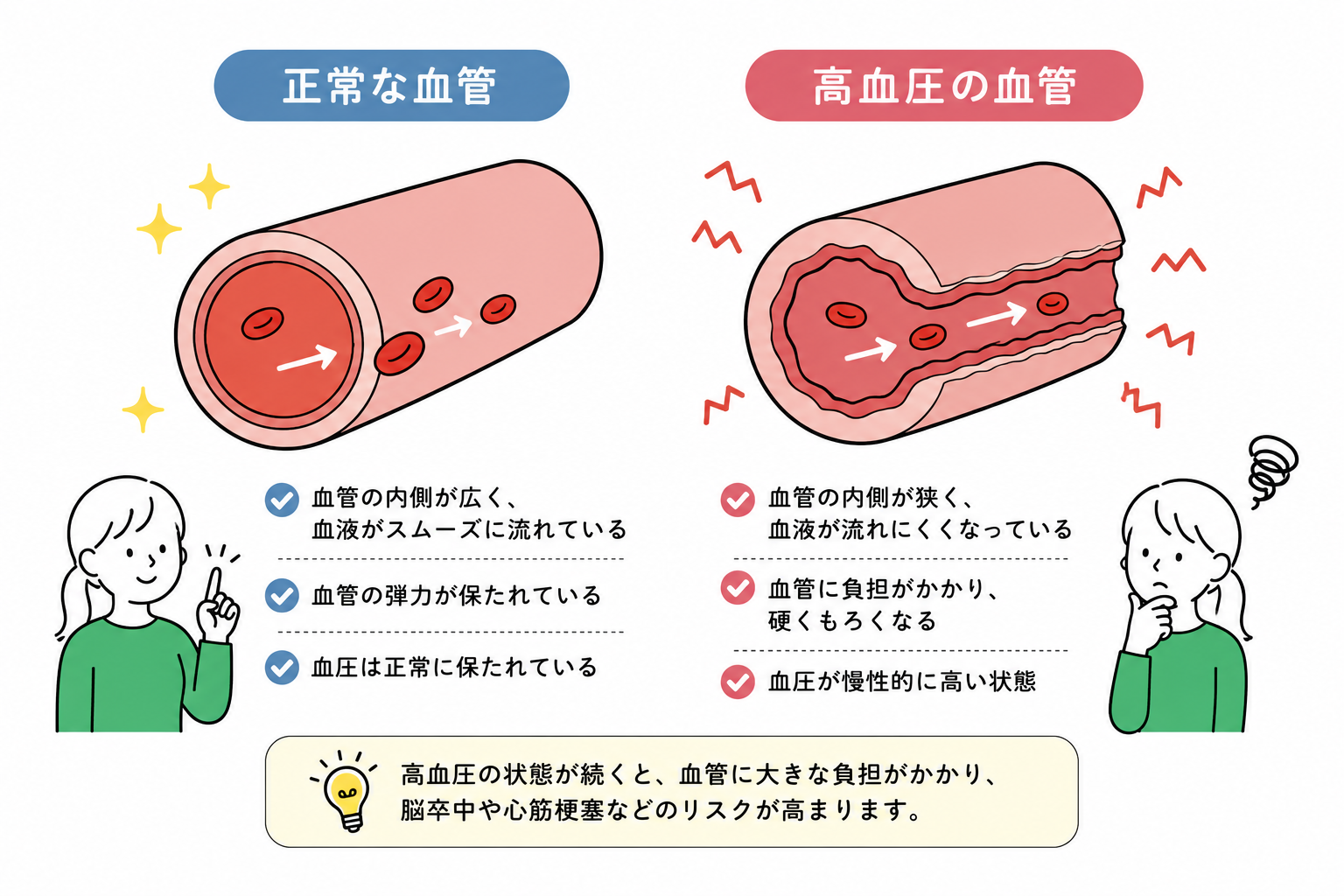 正常な血管と高血圧の血管を比較したイラスト
